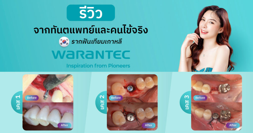 รีวิวจากหมอและคนไข้จริง รากฟันเทียมเกาหลี Warantec