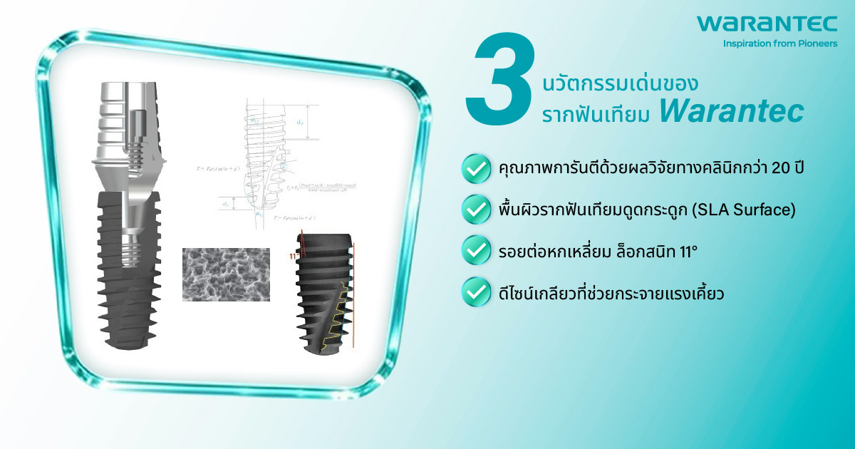 3 นวัตกรรมเด่นของรากฟันเทียม Warantec
